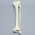 Tibia and Fibula with Spiral Fracture Tibia and Fibula with Spiral Fracture
