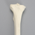 Tibia with Arthritis, Left Tibia with Arthritis, Left