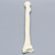 Radius with Transverse Colles' Fracture and Removed Tubercle, Foam Cortical