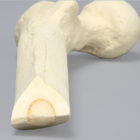 Femur with Plugged Distal Canal, Proximal