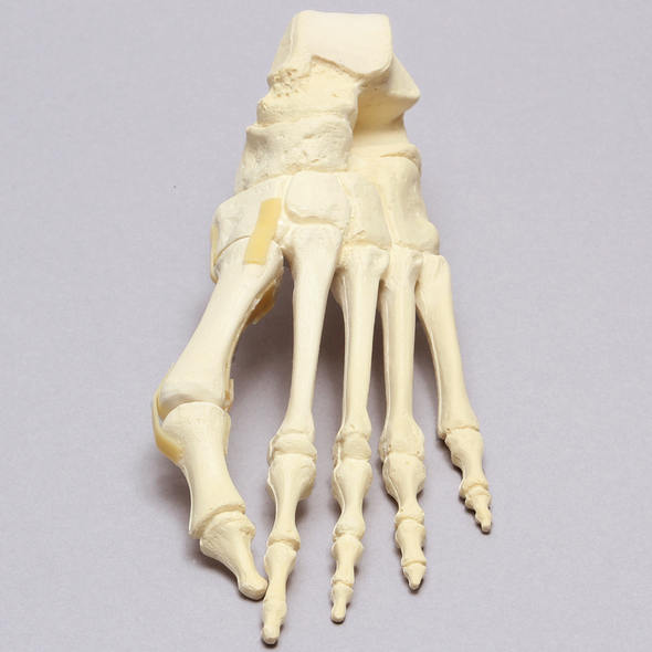 Foot with Valgus Deformity