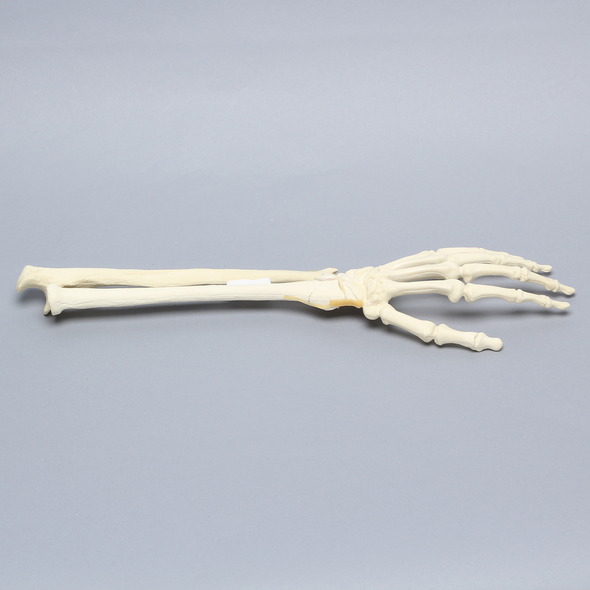 Hand and Wrist with Four-Part Fracture with Displacement, Foam Cortical