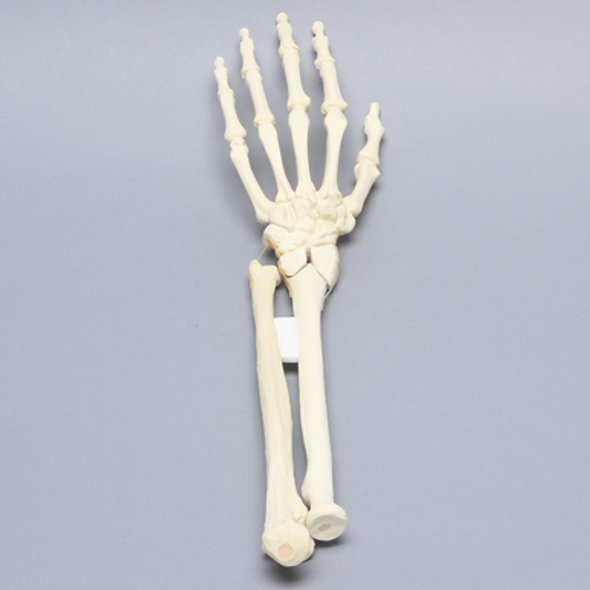 Hand and Wrist with Four-Part Fracture with Displacement, Foam Cortical