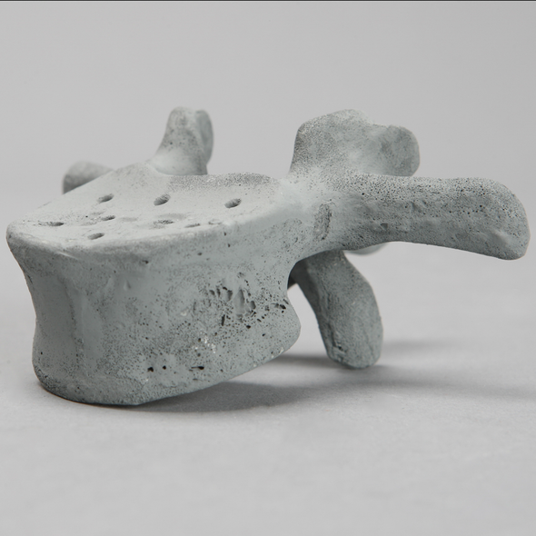 Vertebra, L2, Osteoporotic, Radiopaque