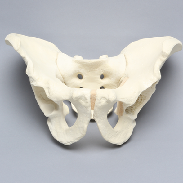 Pelvis with Global and Rim Defects, Full Male, Foam Cortical
