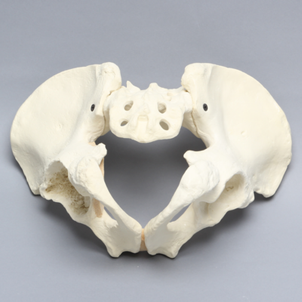 Pelvis with Global and Rim Defects, Full Male, Foam Cortical