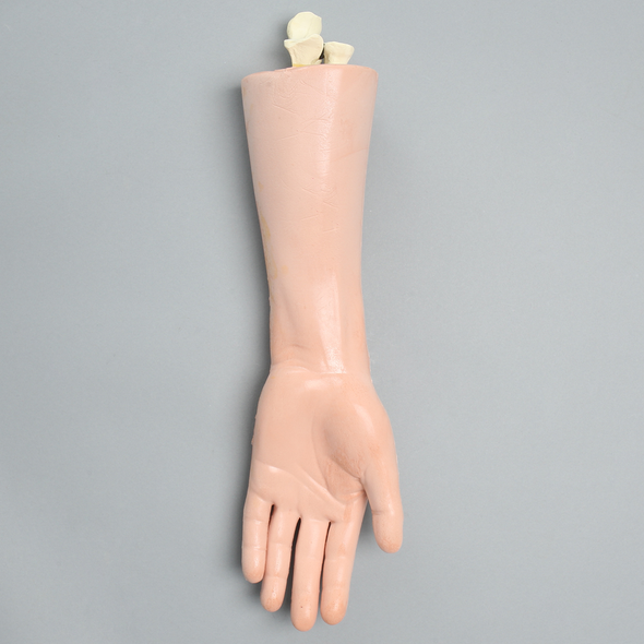 Hand and Wrist with Midshaft Fractures, Encased