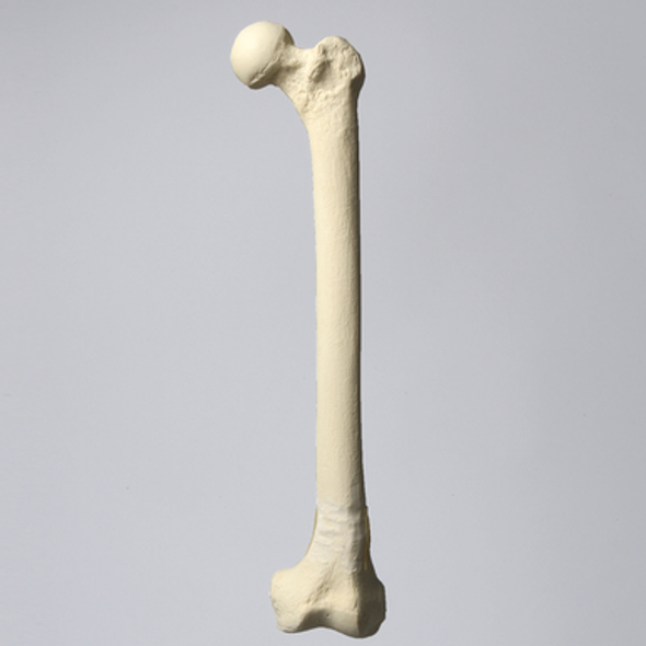 Femur with 10 Degree Varus Deformity