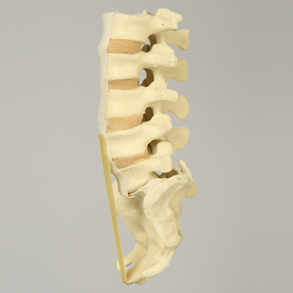 Spine, Lumbar, with L5-Sacrum Grade II Spondylolisthesis
