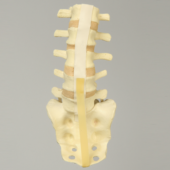 Spine, Lumbar, with L5-Sacrum Grade II Spondylolisthesis