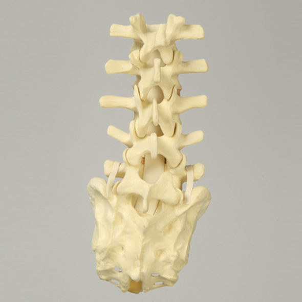 Spine, Lumbar, with L5-Sacrum Grade II Spondylolisthesis