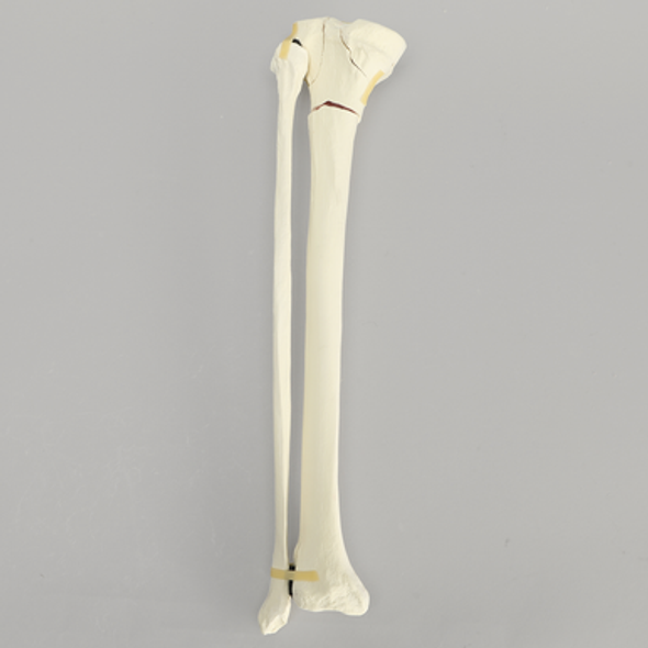 Tibia with Bicondylar and Transverse Fractures and Intact Fibula