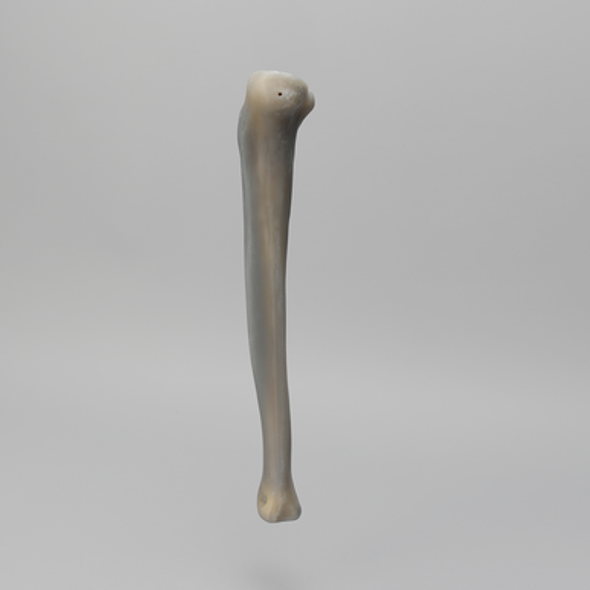 Tibia, absolute™ 4th Gen., 17 PCF, Solid Foam Core with Varus Deformity, Medium