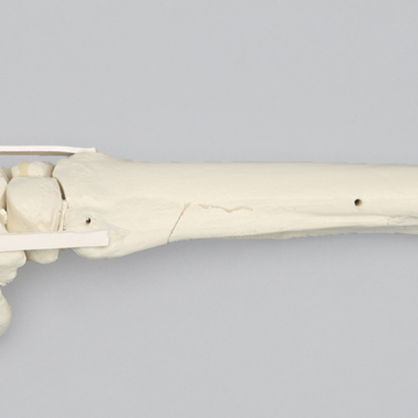 Equine Encased Distal Thoracic Limb with Carpal and Phalanx Fractures