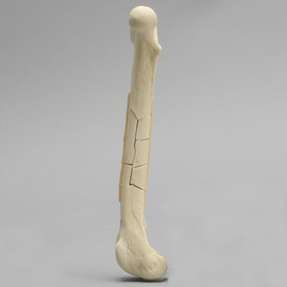 Canine Toy Breed Femur with Comminuted Midshaft Fracture
