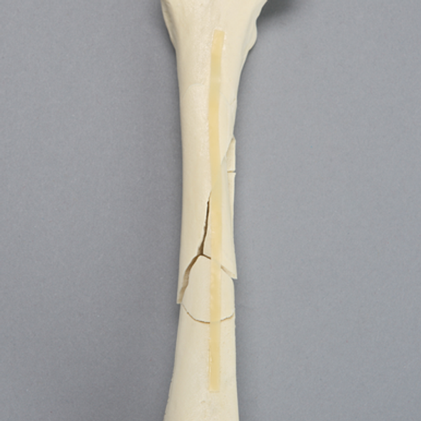 Canine Femur with Comminuted Fracture, Severe