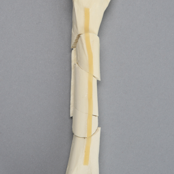 Canine Femur with Comminuted Fracture, Severe