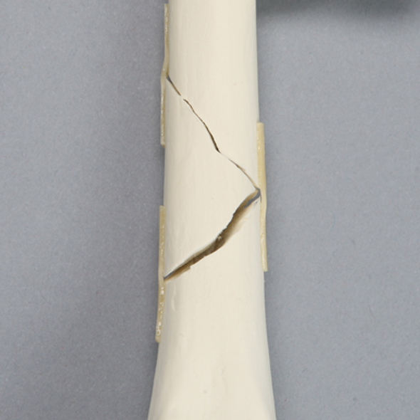 Canine Femur with Three-Part Midshaft Fracture, Foam Cortical