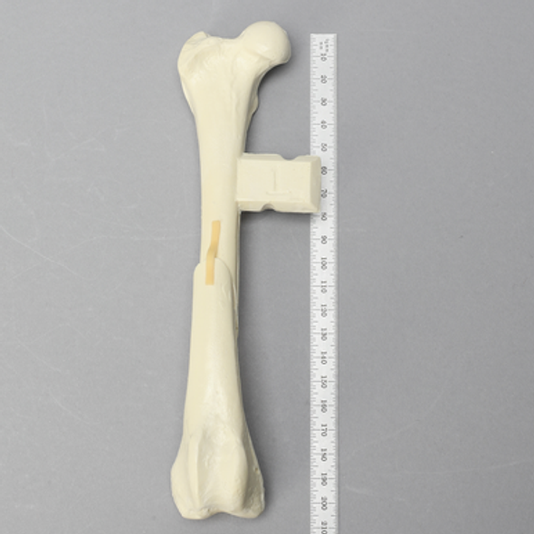Canine Tibia with Midshaft Butterfly Fracture