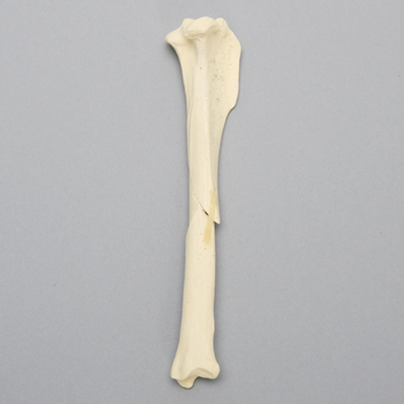 Canine Tibia with Midshaft Butterfly Fracture