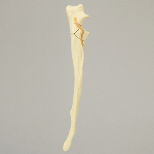 Canine Ulna with Comminuted Olecranon Fracture, Solid Foam