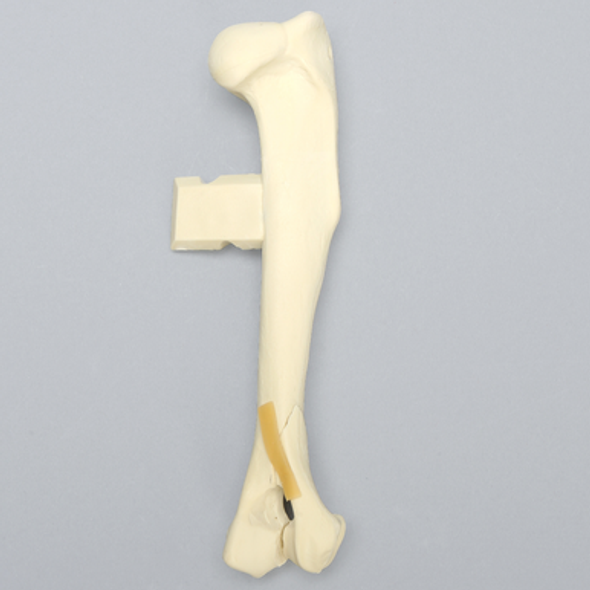 Canine Humerus with Distal Condylar Fracture, Foam Cortical