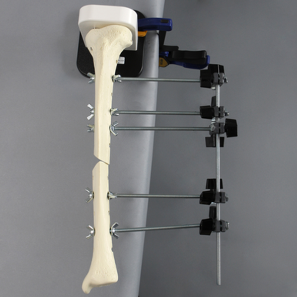 Orthopaedics in Action® Engineering an Ex-Fix Module