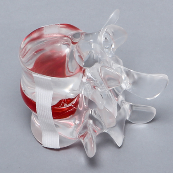 Lumbar Vertebrae L4-L5 with Gel-filled Nucleus, Solid Clear Plastic