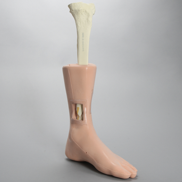 Foot and Ankle with Windows and Tibial and Fibular Fractures, Encased