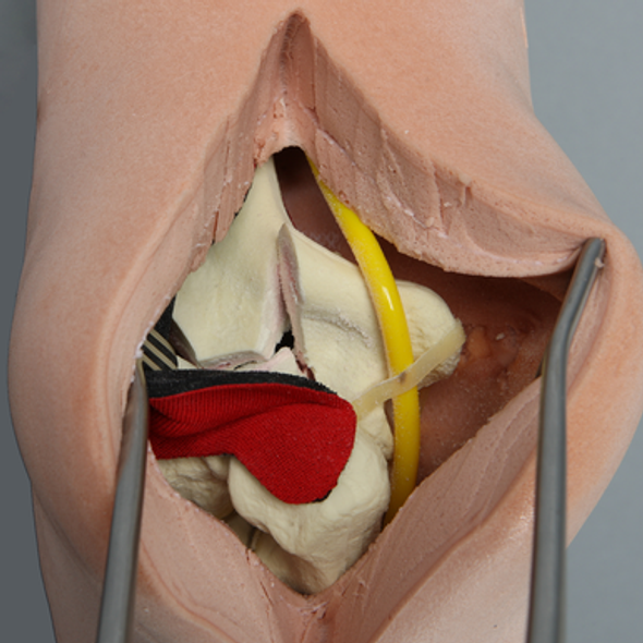 Elbow with Nerve, Tendon, and Four-Part Humeral Fracture, Encased