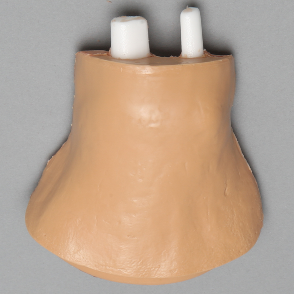 Arthroscopy Wrist Insert with Carpal Defects