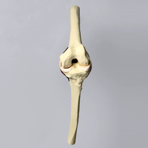 Knee, ACL with 3.2 mm/10 mm Step Tunnel , Solid Foam