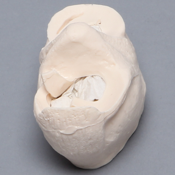 Meniscal Insert with Flap, Transverse, and Longitudinal Tears