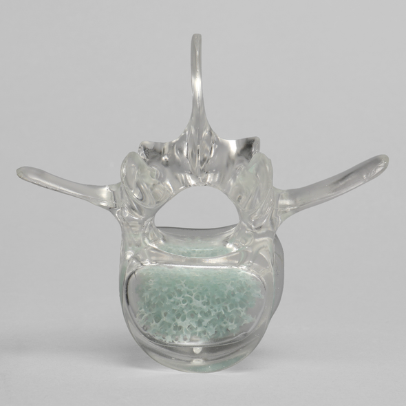 Vertebra L3 with Replaceable Cancellous Insert
