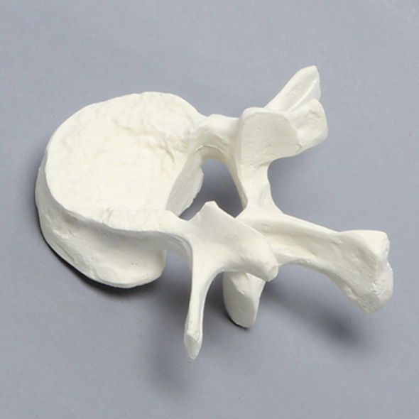 Vertebra, L1, Fractured, Solid Foam