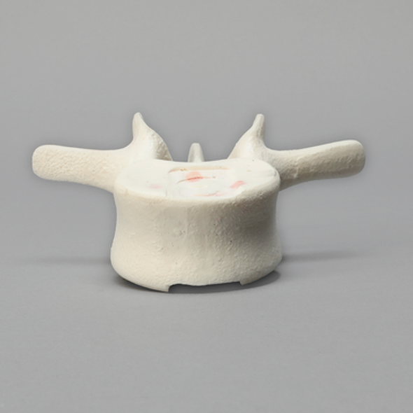 Vertebra, L3, Foam Cortical Shell, For Spinal Navigation