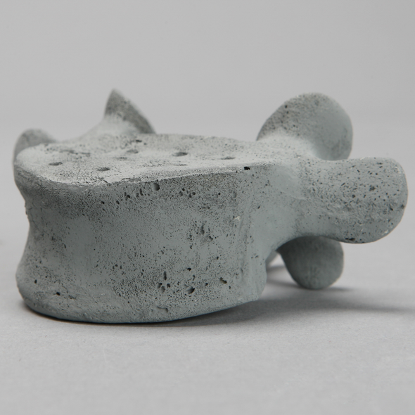 Vertebra, L5, Osteoporotic, Radiopaque
