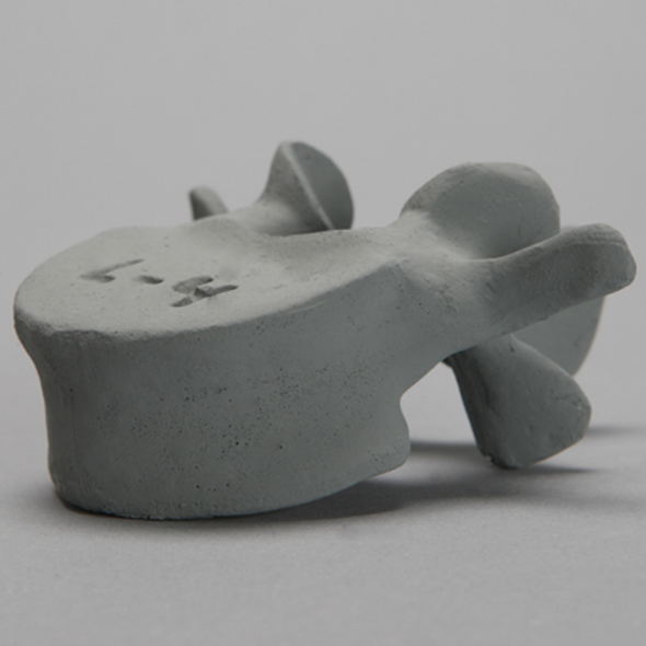 Vertebra, L4, Osteoporotic, Radiopaque