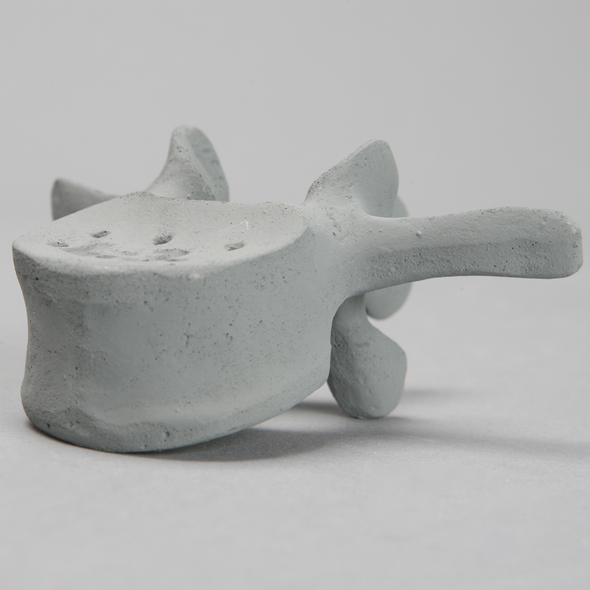 Vertebra, L3, Osteoporotic, Radiopaque