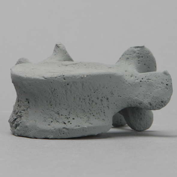 Vertebra, L5, Radiopaque