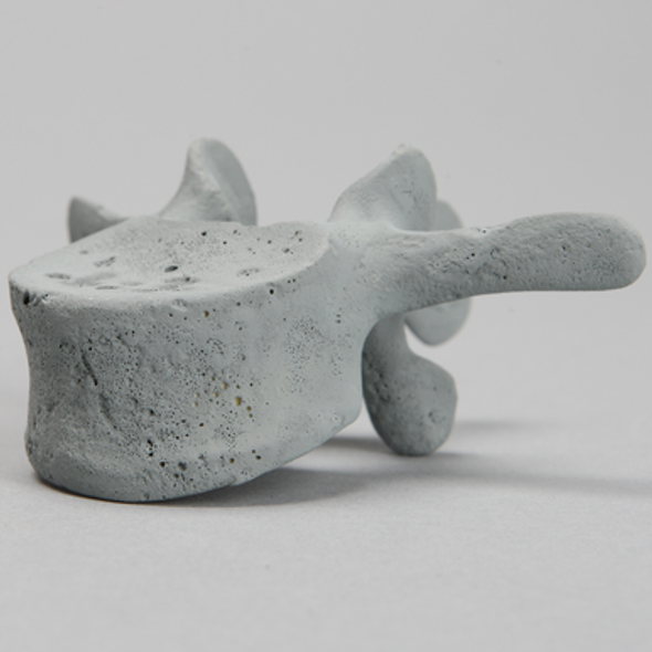 Vertebra, L3, Radiopaque