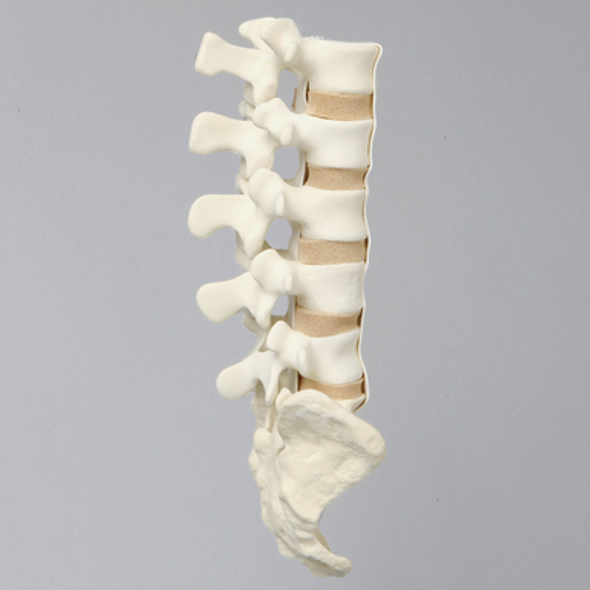 Spine, Lumbar with Flat Back Pathology, Foam Cortical