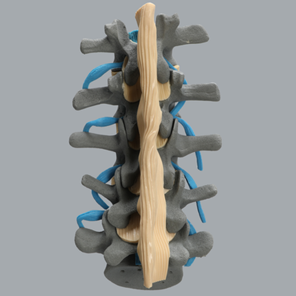 Spine, Lumbar with Nerve Roots, Flava and Interspinous Ligaments, Radiopaque