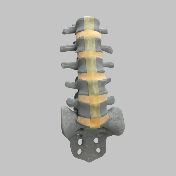 Spine, Lumbar, L1-Sacrum, Osteoporotic Vertebrae, Radiopaque