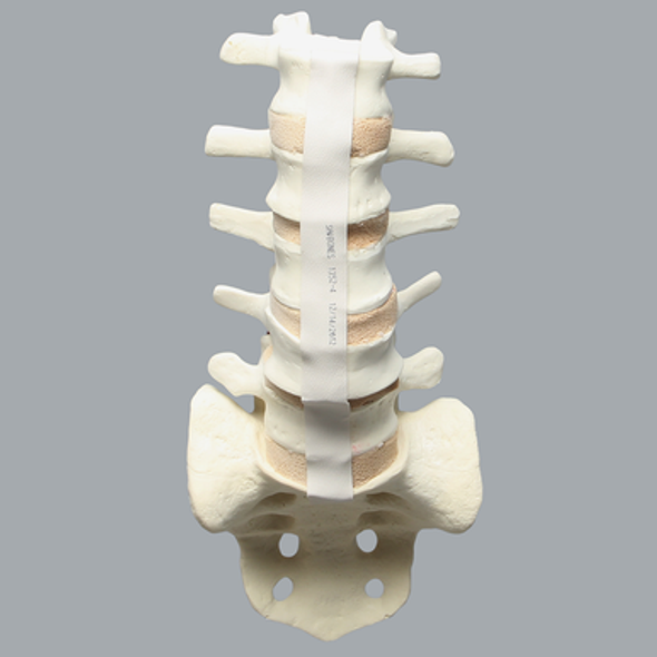 Spine, Lumbar with L4 Spondylolisthesis, Solid Foam