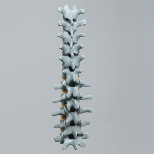 Spine, Lumbar, T7-L5, Osteoporotic Vertebrae, Radiopaque