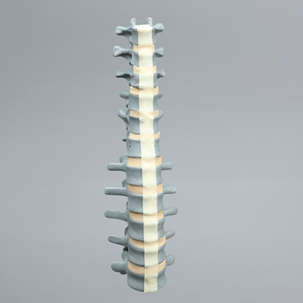 Spine, Lumbar, T7-L5, Osteoporotic Vertebrae, Radiopaque