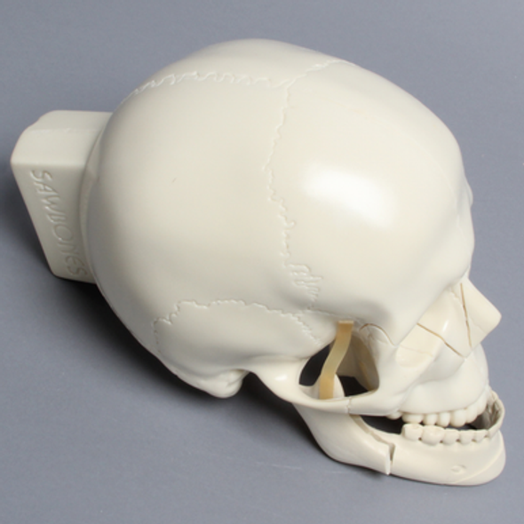 Skull, Full, With All Le Fort Fractures, Sagittal Split, and Genioplasty
