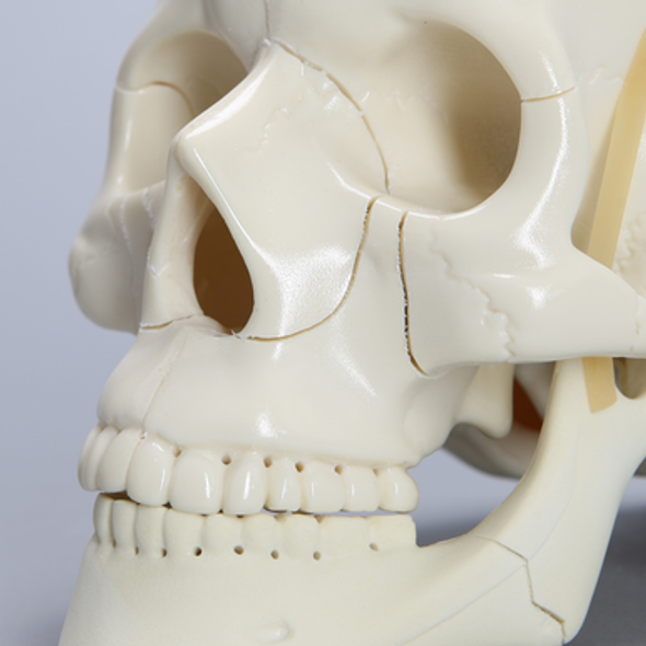 Skull, Full, With Le Fort II, Zygomatic, and Mandible Fractures