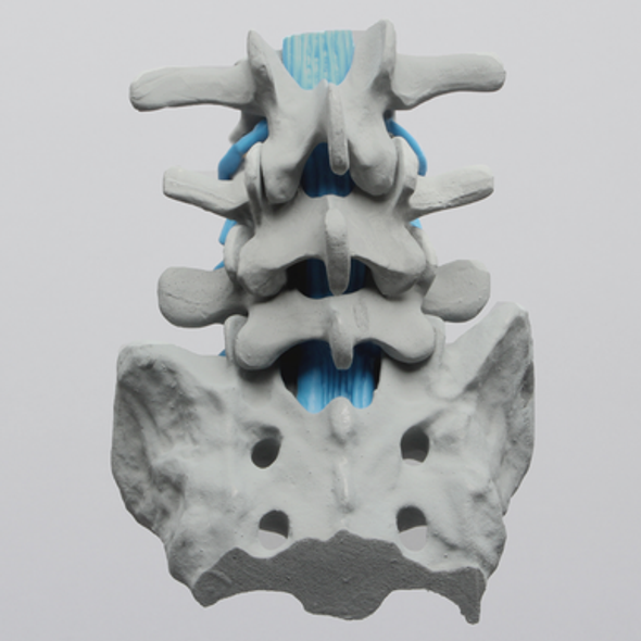 Spine, Lumbar with Partial Sacrum and Nerve Roots, Radiopaque